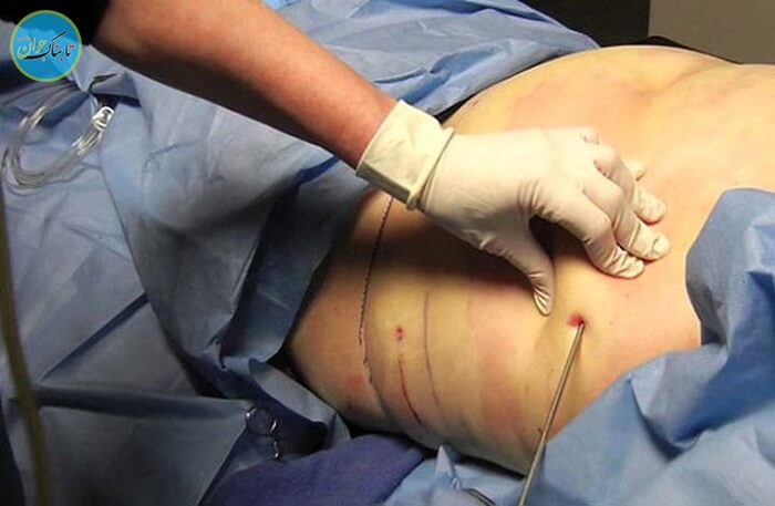 لیپوساکشن چیست