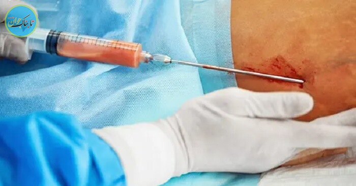 عمل لیپوساکشن