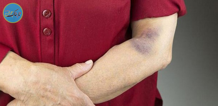 کبودی پوست نشانه پایین بودن پلاکت خون