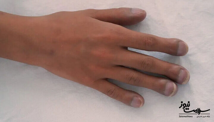 ۱۲ علامت هشدار دهنده بیماری قلبی که روی پوست ظاهر می‌شود