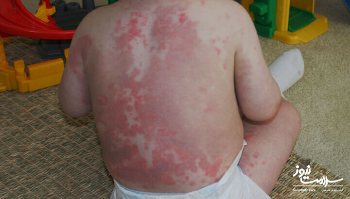 ۱۲ علامت هشدار دهنده بیماری قلبی که روی پوست ظاهر می‌شود