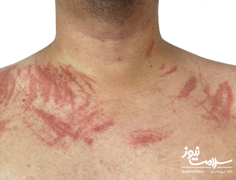 علائم هشدار دهنده «بیماری کلیوی» که روی پوست ظاهر میشوند/ این نشانهها را جدی بگیرید