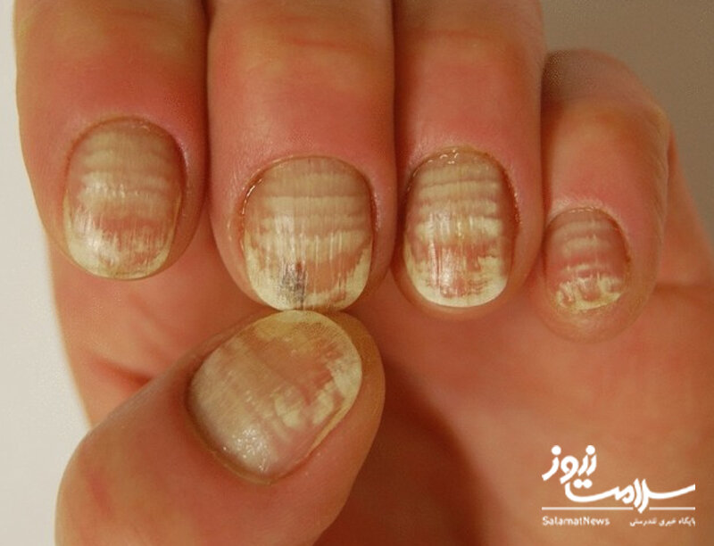 علائم هشدار دهنده «بیماری کلیوی» که روی پوست ظاهر میشوند/ این نشانهها را جدی بگیرید