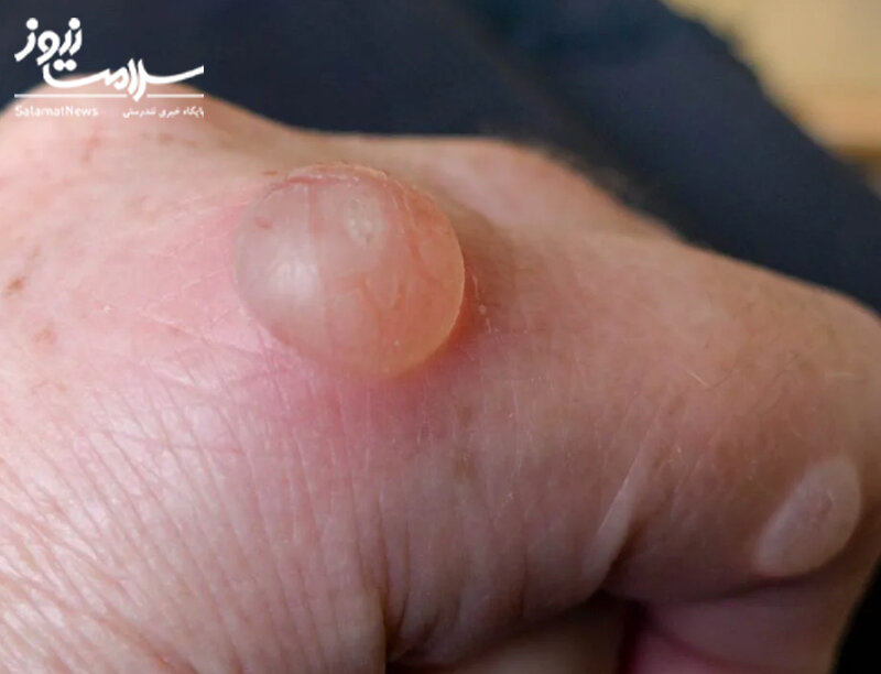 علائم هشدار دهنده «بیماری کلیوی» که روی پوست ظاهر میشوند/ این نشانهها را جدی بگیرید