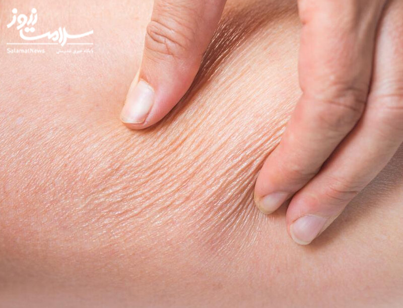 علائم هشدار دهنده «بیماری کلیوی» که روی پوست ظاهر میشوند/ این نشانهها را جدی بگیرید