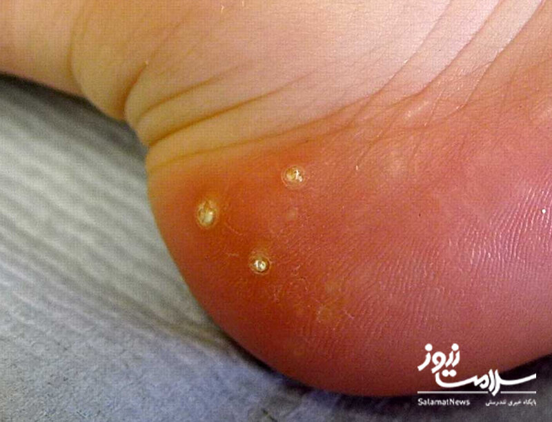 علائم هشدار دهنده «بیماری کلیوی» که روی پوست ظاهر میشوند/ این نشانهها را جدی بگیرید