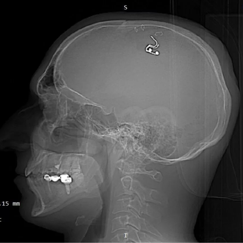 یک محقق روسی با دریل مغزش را سوراخ کرد و در آن تراشه کاشت!/ عکس