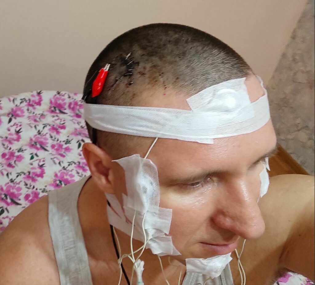 یک محقق روسی با دریل مغزش را سوراخ کرد و در آن تراشه کاشت!/ عکس