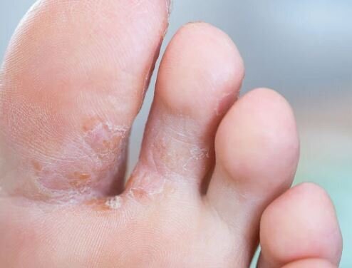 عفونتهای قارچی پا، مراقب اتاق پرو و کفشفروشیها باشید!