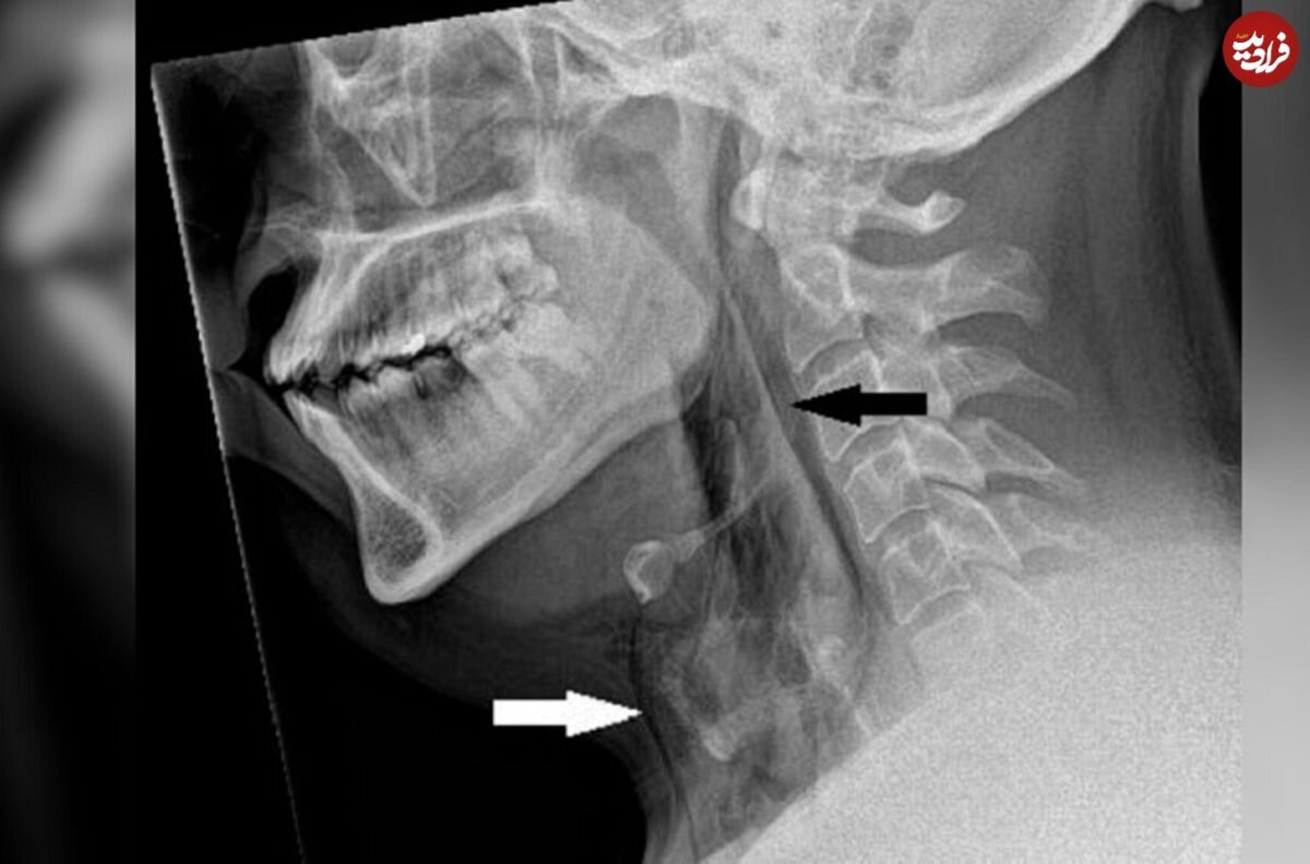 ثبت یک مورد عجیب سوراخ شدن «نای» در اثر نگه داشتن عطسه/ عکس