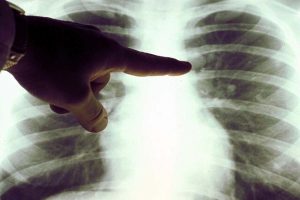 عکس سی تی اسکن از قفسه سینه که باانگشت اشاره نشان داده میشود