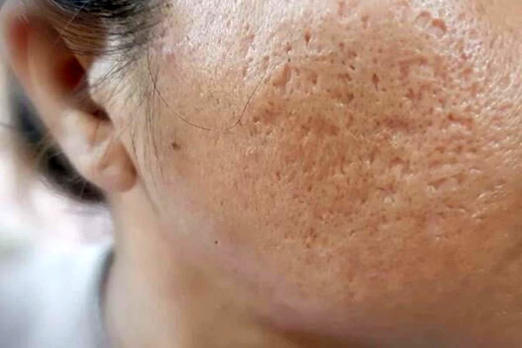 روش های ساده برای محو کردن جای زخم‌