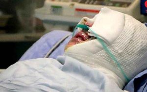 عکسی از شخصی که با اسید مجروح شده است