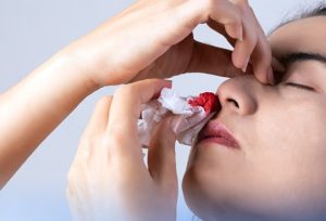 عکسی از خونریزی بینی