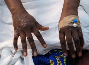 افزایش شمار قربانیان آبله میمونی در آفریقا؛ تلفات از ۱۰۰۰ نفر فراتر رفت